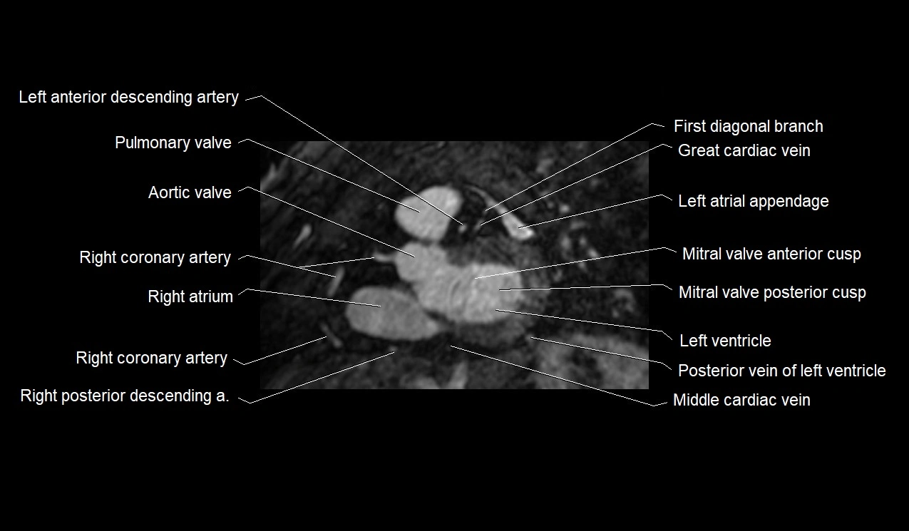 MRI heart and coronary arteries short axis anatomy image 19.webp